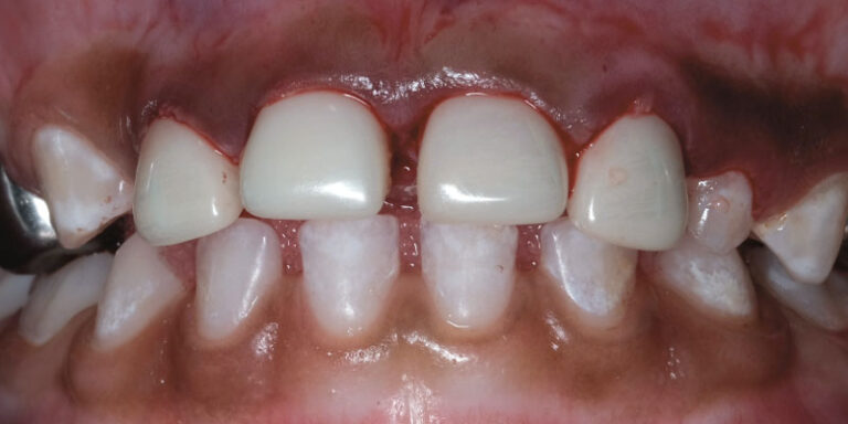 The rationale for full coverage esthetic crowns: a case series