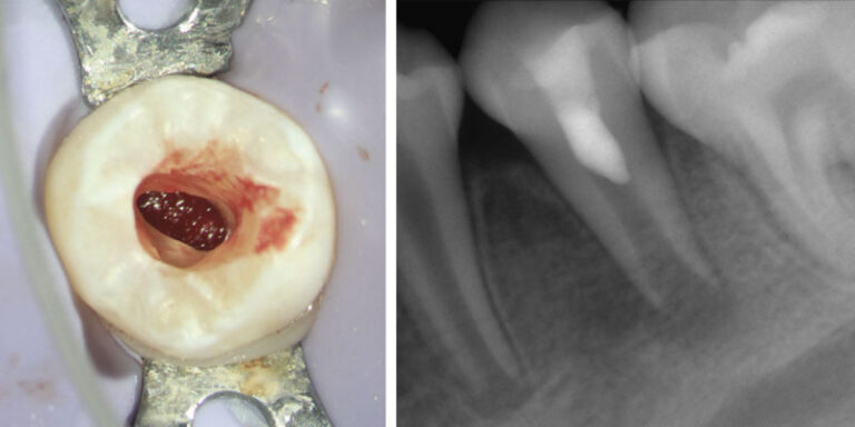 Single visit regenerative endodontics using the GentleWave® Procedure: a pediatric case report