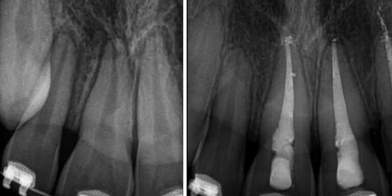 The importance of calcium hydroxide in dental trauma cases