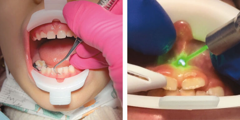 Your “third hand” in pediatric dentistry — less stress, more smiles