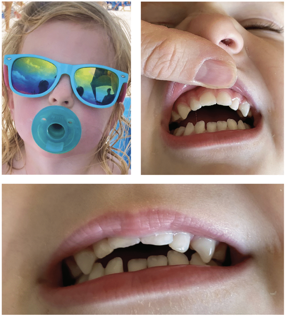 Figures 1A-1C: Severe dental protrusion for a 3-year-old-child caused by the long-term useof a pacifier